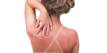 Tras años de estudios: identificada la causa principal de las quemaduras solares