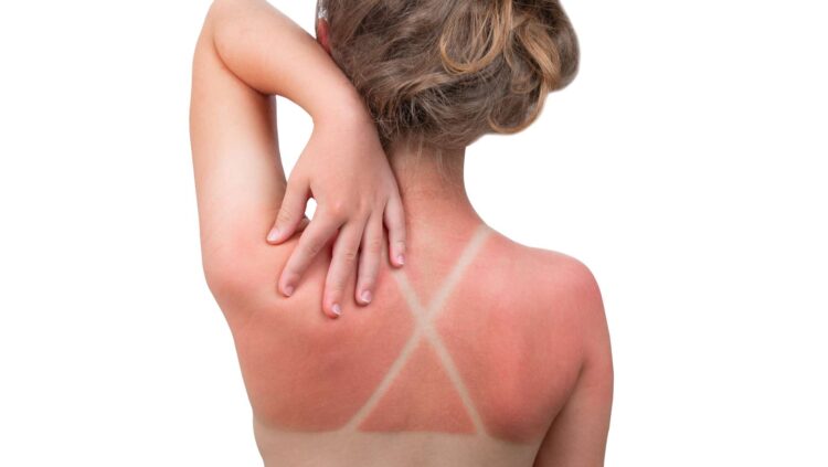 Tras años de estudios: identificada la causa principal de las quemaduras solares