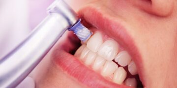 Elimina el sarro de tus dientes en casa con este truco natural.