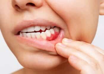 Natural plant compound could revolutionize gum disease treatment