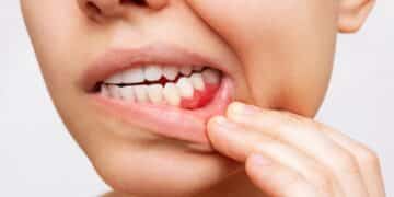 Natural plant compound could revolutionize gum disease treatment