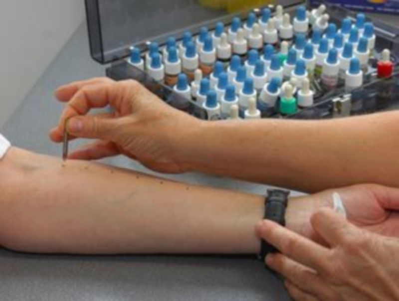 Pruebas que se realizan en el servicio de Alergología del Hospital General./FERNANDO PEÑALOSA