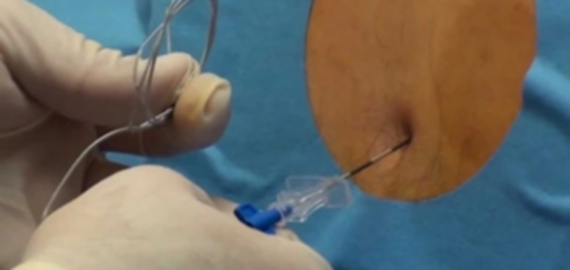 La aplicación de la epidural está en la cartera del hospital desde el año 2.000. / E. A.