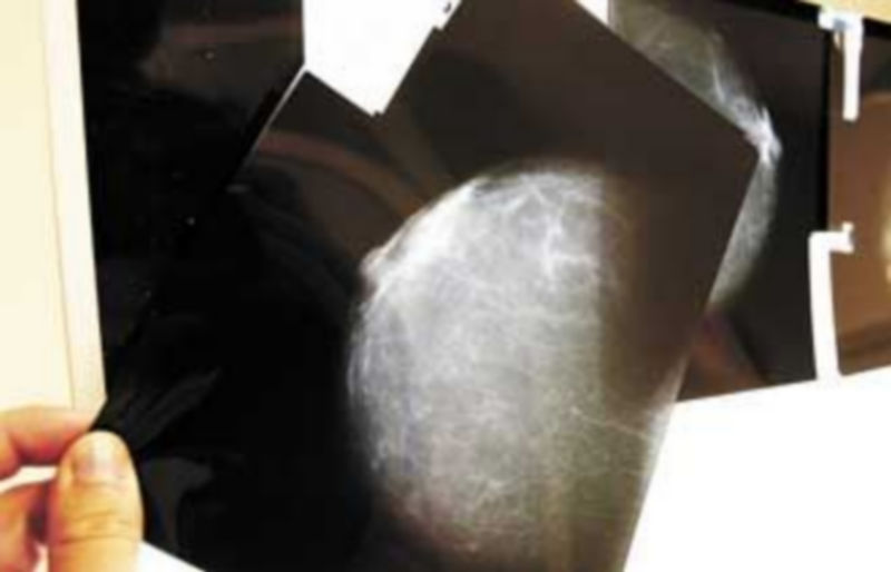 Una radiografía del pecho de una mujer donde ha sido detectado un tumor. / Efe