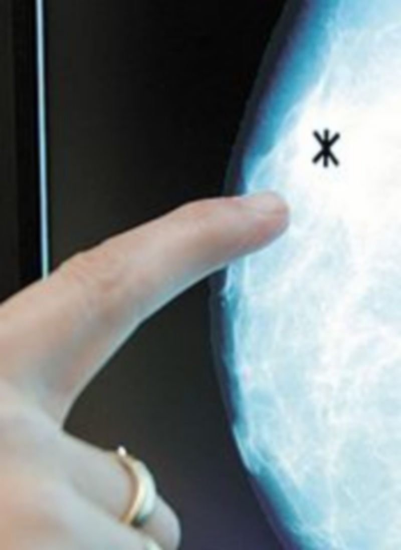 Mamografía con un tumor.