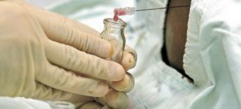Un médico extrae material medular