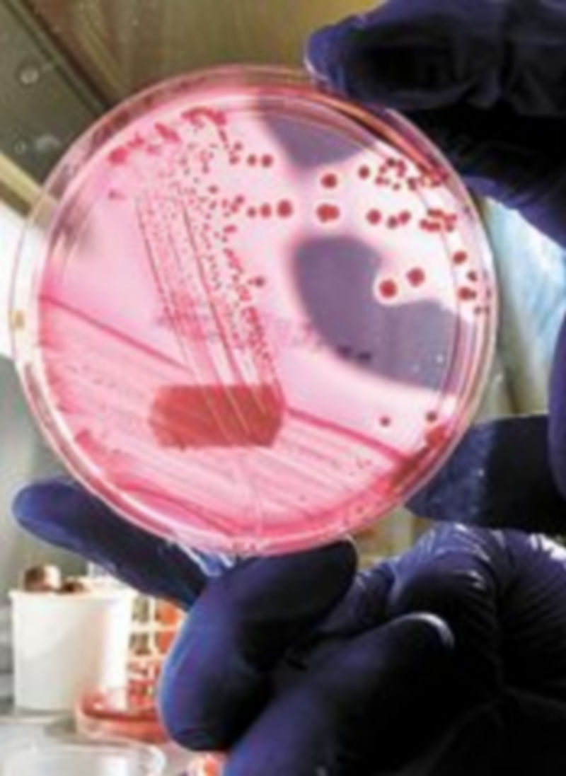 El tumor de colon es el más común.