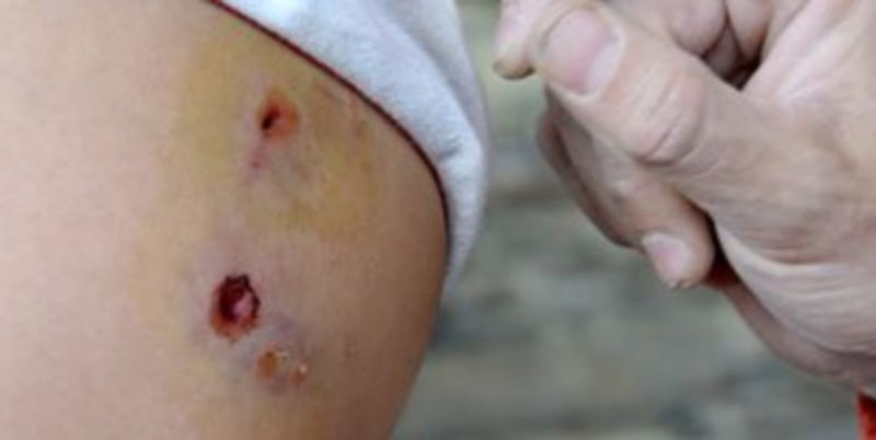 Los perros provocaron graves daños en las piernas de la niña de siete años