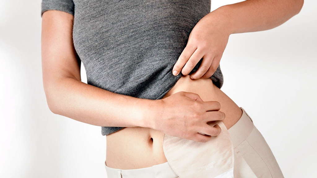 Unos 240 pacientes de la provincia de Segovia portan una ostomía 1 Cerca de 100.000 personas en España tienen una ostomía, una apertura en el abdomen para eliminar desechos. / EUROPA PRESS