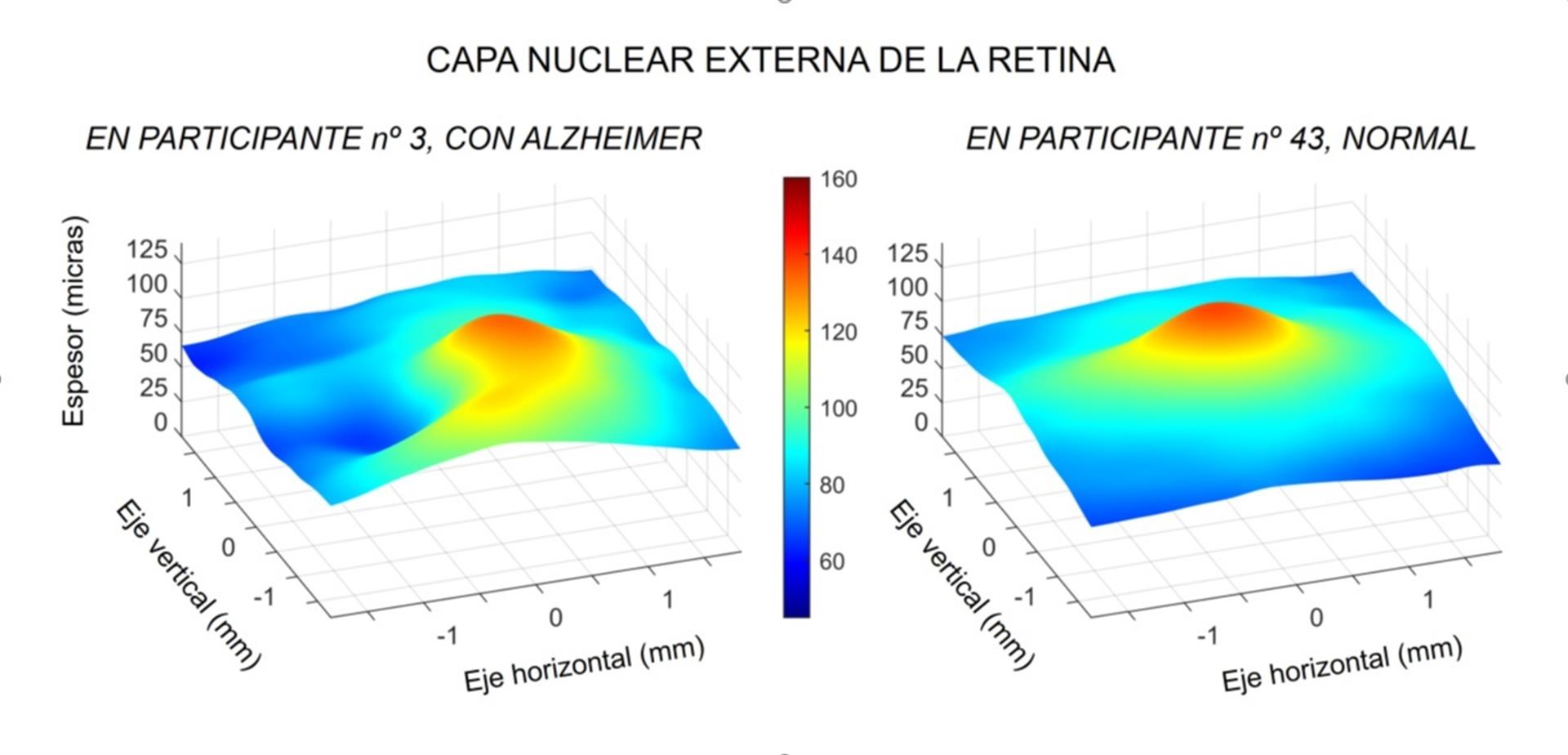 estudio retina alzheimer