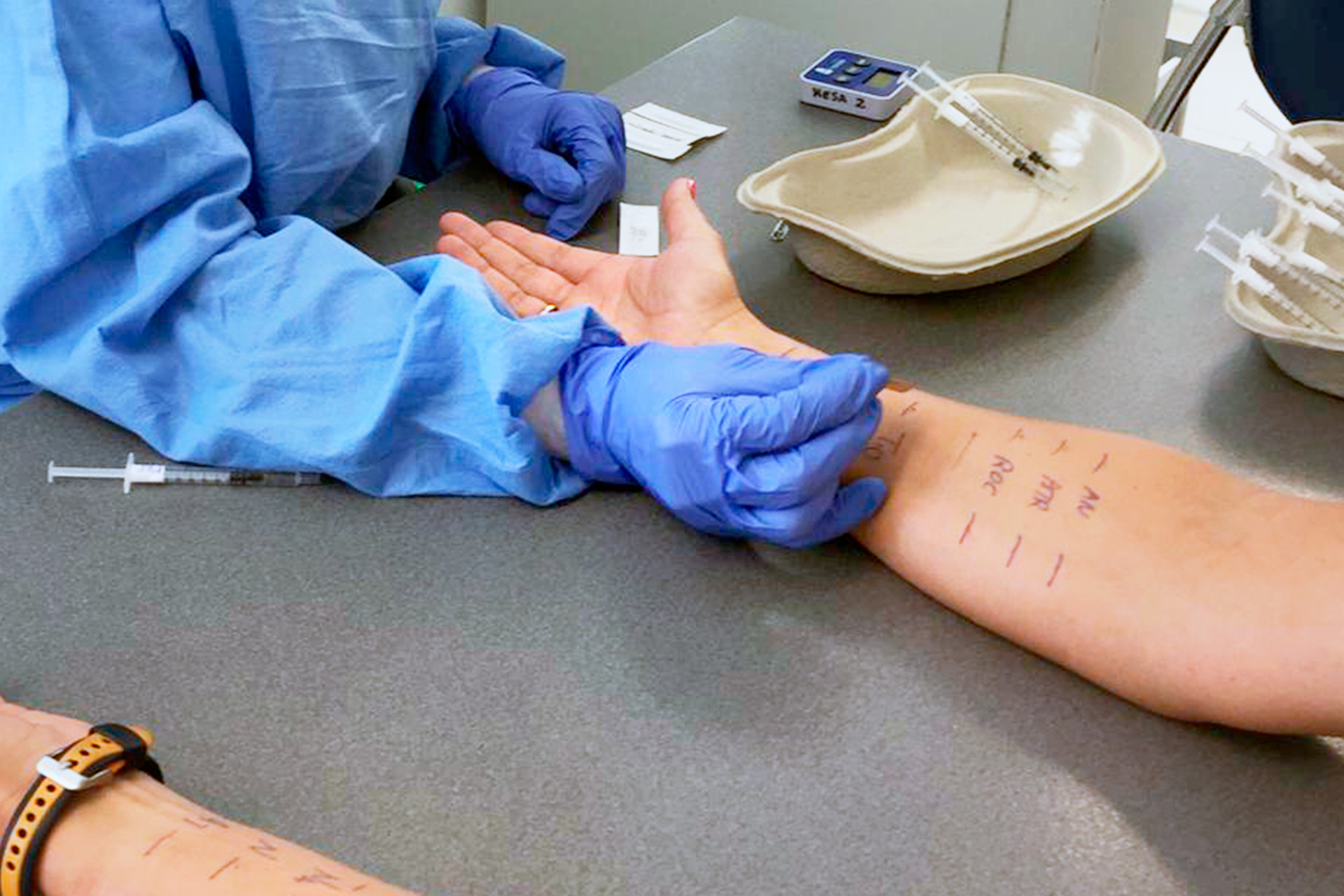Pruebas en el brazo para comprobar reacciones alérgicas. /EA