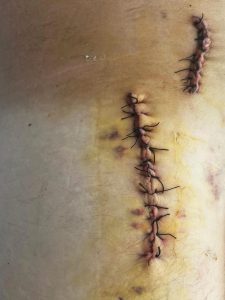 El banderillero Víctor Pérez recibie el alta y reaparece el domingo en Salamanca tras la cornada en Calasparra 2 cornada victor perez